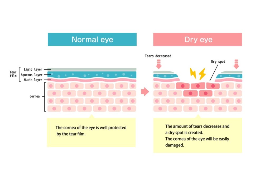Medical diagram comparing normal eye tear film structure with dry eye condition, showing the three tear film layers and how decreased tears create dry spots on the cornea.